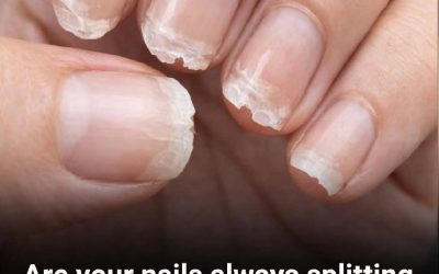 Brittle and Weak Nails: What Your Body Is Telling You
