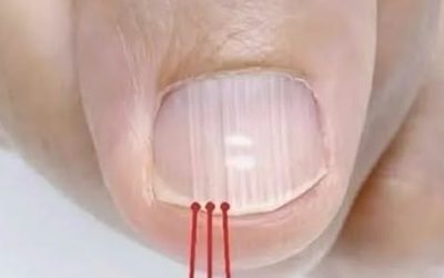 If you have these lines on your nails after 40, it is a clear sign that..