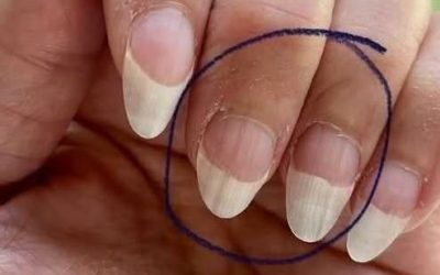 What do white lines on the nails mean?