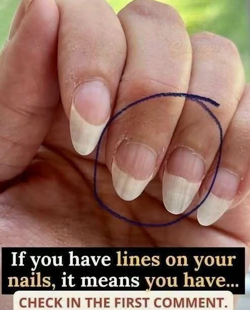 What do white lines on the nails mean?